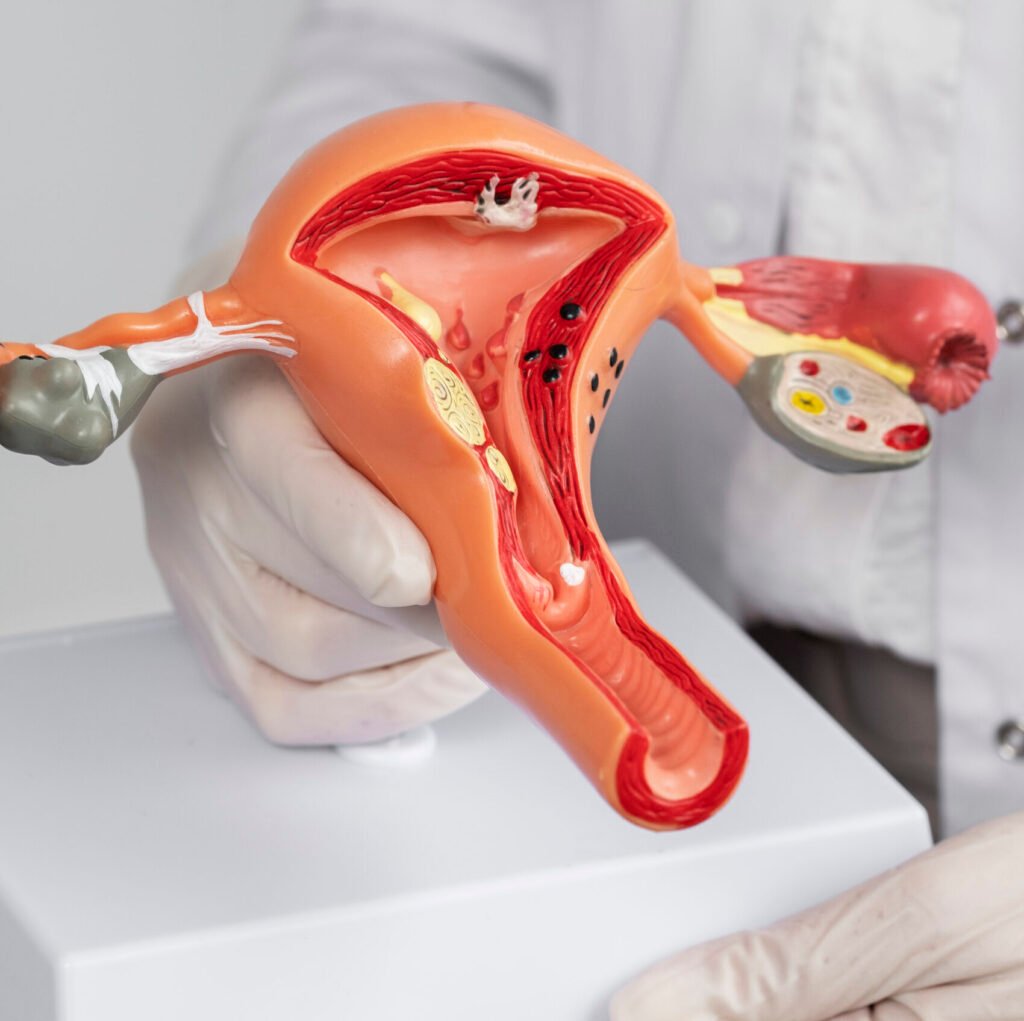 Advanced uterine fibroid treatment in Indore by gynecologist Dr. Deepali Mittal.