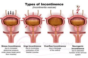 Best Urge Incontinence Treatment in Indore for women with bladder leakage and urinary urgency symptoms